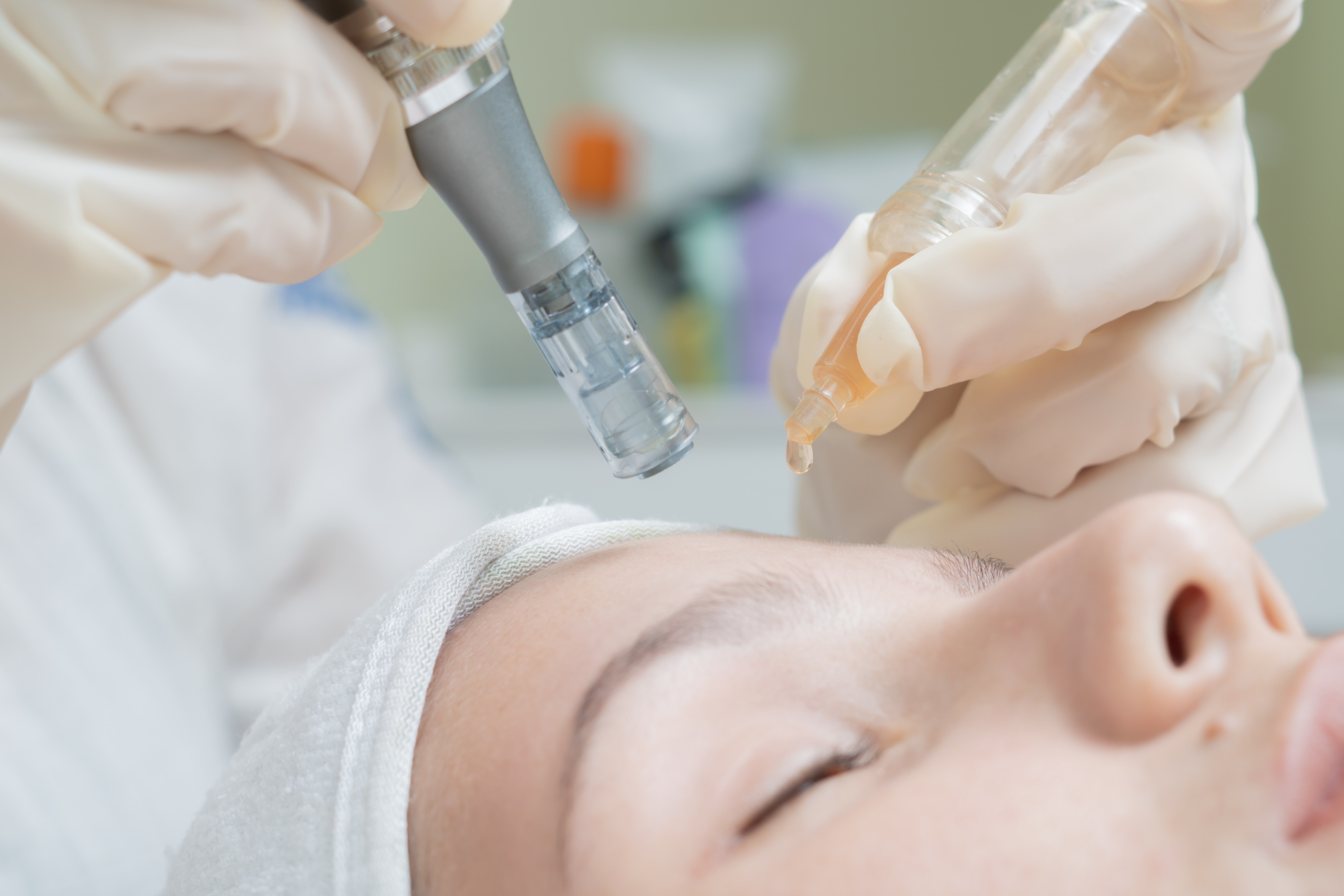 Micropunción facial